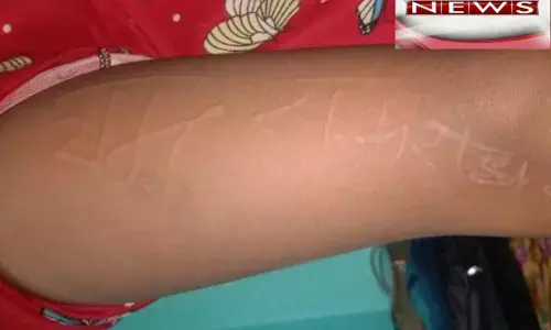 डॉक्टर हुए हैरान बच्ची के शरीर पर देवी देवताओं के नाम कभी राधे तो कभी राम उभरते व मिटते गांव वाले बता रहे कोई देवी शक्ति डॉक्टर हुए हैरान बच्ची के शरीर पर देवी देवताओं के नाम कभी राधे तो कभी राम उभरते व मिटते गांव वाले बता रहे कोई देवी शक्ति