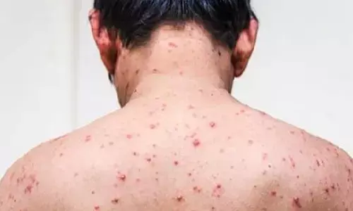 Chickenpox Kerala: केरल में तेजी से फैल रहा है चिकनपॉक्स, 6 हजार से ज्यादा मामले आए सामने