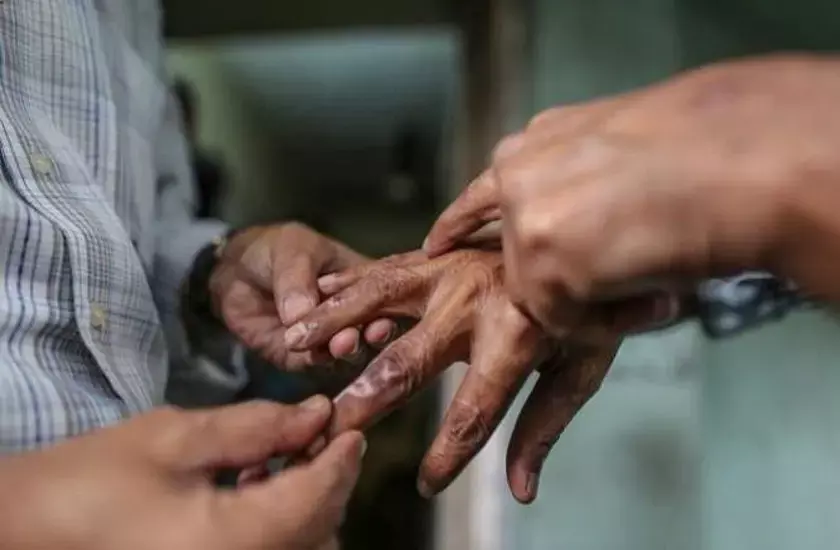 जब कुष्ठ रोग लाइलाज नहीं तो शोषण और भेदभाव क्यों? जब कुष्ठ रोग लाइलाज नहीं तो शोषण और भेदभाव क्यों?