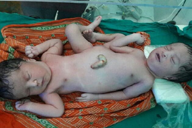 जन्मा अनोखा बच्चा, एक शरीर से जुड़े दो सिर, हाथ 4 और पैर 2