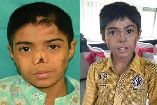 बच्चे के माथे पर डॉक्टरों ने उगा दी नाक बच्चे के माथे पर डॉक्टरों ने उगा दी नाक