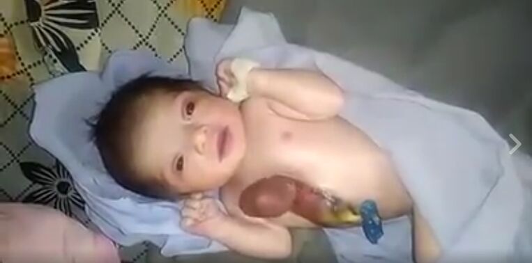 अनोखी बच्ची ने हॉस्पिटल में लिया जन्म,सीने के अंदर नहीं बल्कि बाहर धड़क रहा है बच्ची का दिल, देखें वीडियो अनोखी बच्ची ने हॉस्पिटल में लिया जन्म,सीने के अंदर नहीं बल्कि बाहर धड़क रहा है बच्ची का दिल, देखें वीडियो