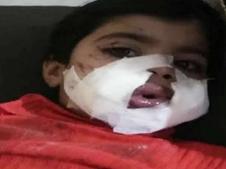 युवक ने बच्ची के मुंह में देकर फोड़ा सुतली बम, मासूम का उडा जबड़ा निकल गई चीख युवक ने बच्ची के मुंह में देकर फोड़ा सुतली बम, मासूम का उडा जबड़ा निकल गई चीख