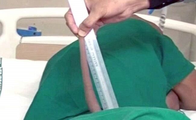 गजब! इस लड़के को थी 7 इंच लंबी पूंछ, 6 डॉक्टर्स की टीम ने सर्जरी से हटाया, देखें वीडियो