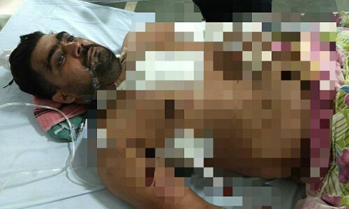 BHU: डेढ़ घंटे जटिल ऑपरेशन कर दिया नया जीवन