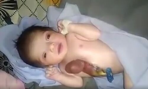 अनोखी बच्ची ने  हॉस्पिटल में लिया जन्म,सीने के अंदर नहीं बल्कि बाहर धड़क रहा है बच्ची का दिल, देखें वीडियो