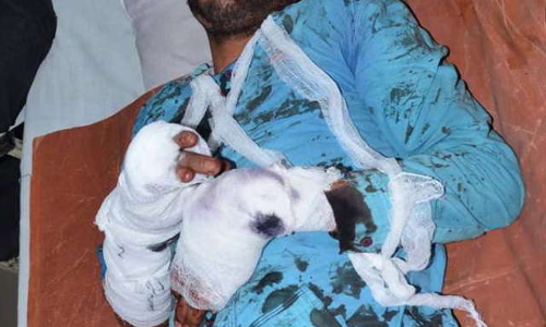 वाइक पर आया स्कैच तो काट डाले सगे भाई ने हाथ,  हालत गंभीर