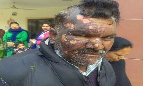 भटिंडाः बम ब्लास्ट में गंभीर रूप से घायल पंहुचा वोट डालने भटिंडाः बम ब्लास्ट में गंभीर रूप से घायल पंहुचा वोट डालने