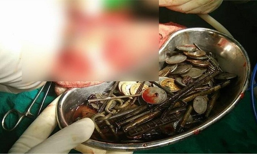 मेटलफ्रेजिया बीमारी से ग्रस्त शख्स खाता था कुछ अलग ही, अॉपरेशन कर डॉक्टर भी रह गए हैरान