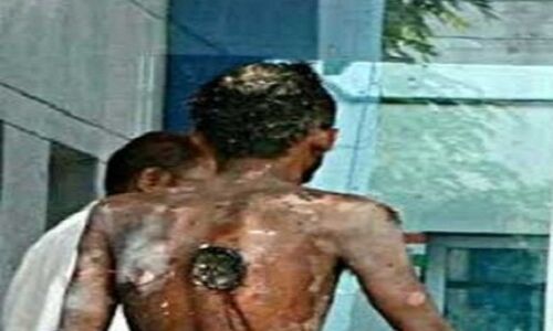 कानपूर: हैलट में डॉक्टर बने जल्लाद, मरीज का सिर खा गए कीड़े