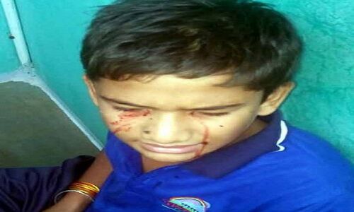 खून के आंसू रोता है 13 साल का ये बच्चा, डॉक्टर भी है हैरान