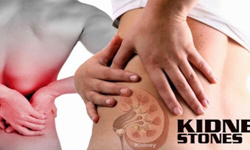 बिना ऑपरेशन निकल जाएगी किडनी की पथरी, आजमाएं ये 10 घरेलू नुस्खे